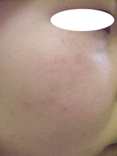 スキンクリニック山本皮フ科 フォトｒｆ オーロラ フォトｒｆリファーム