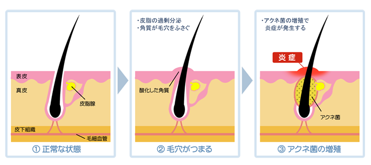 ニキビのメカニズムのイラスト1